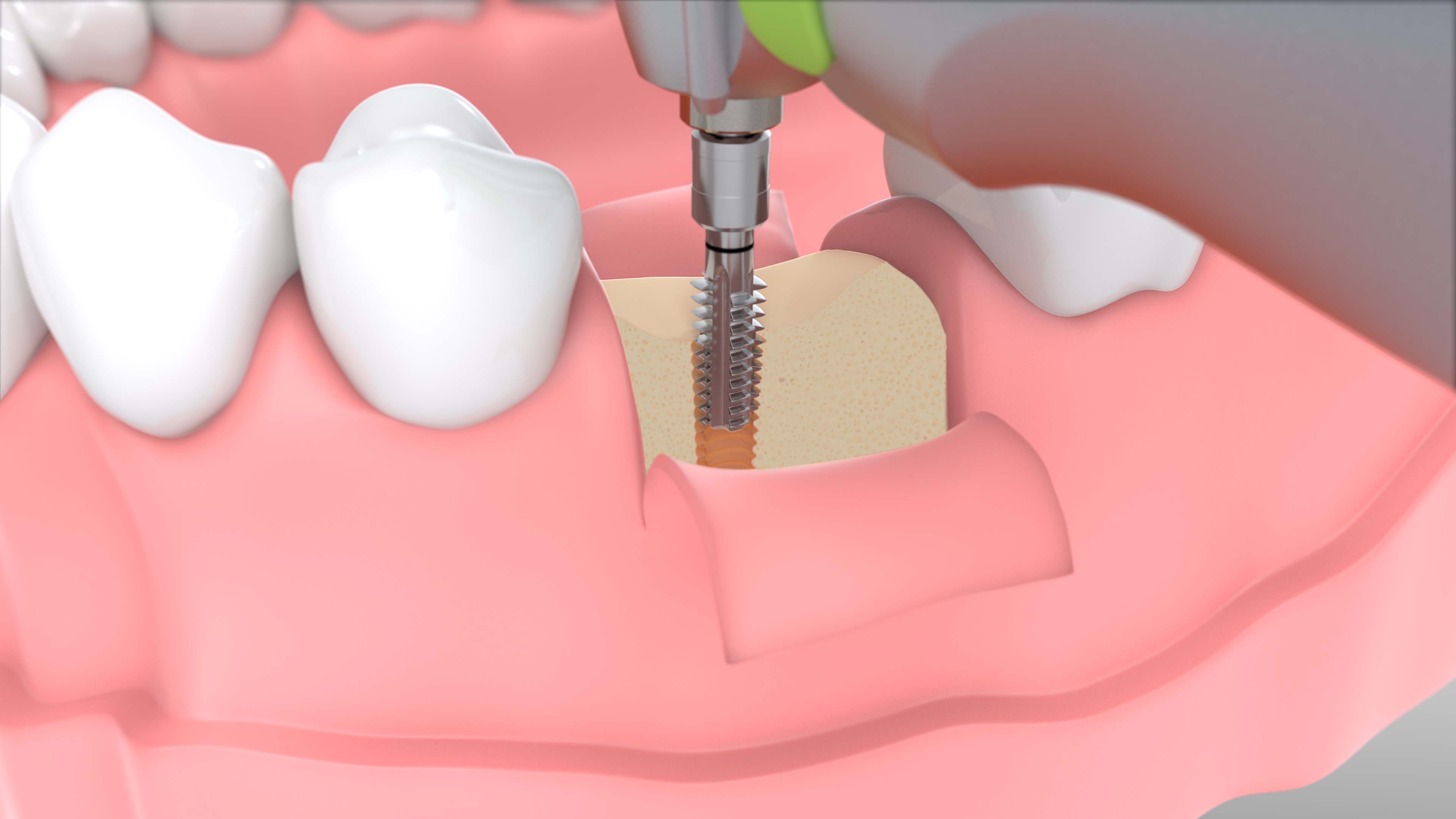 W&H Implantmed Plus SI-1023, Chirurgie-Einheit, ultrakurzer DC-Motor EM-19
